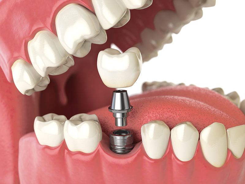 history of dental implants